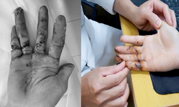 Ngày đầu đi làm, thanh niên 17 tuổi suýt mất 3 ngón tay vì máy cưa