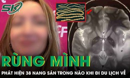 Rùng mình: Cô gái tá hỏa phát hiện 38 nang sán trong não