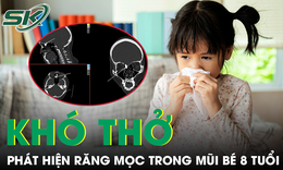 Bác sĩ phát hiện nguyên nhân bất ngờ khiến bé gái 8 tuổi nghẹt mũi nhiều năm