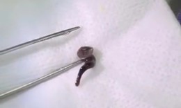 Uống nước ở suối, nam thanh niên bị con đỉa dài 2,5cm chui vào mũi