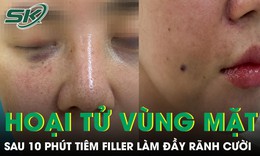 Cô gái 29 tuổi hoại tử vùng mặt sau 10 phút tiêm filler làm đầy rãnh cười 