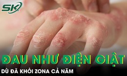 Khỏi zona cả năm vẫn bị những cơn đau như điện giật hành hạ 