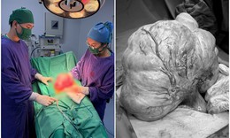 Bụng to tưởng tăng cân, người phụ nữ đi khám phát hiện khối u gần 3 kg