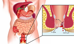 6 sai lầm khiến nhiều người điều trị trĩ thất bại