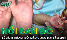 Tưởng bệnh da liễu, bé 2 tháng tuổi mắc giang mai