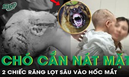 Bé trai 2 tuổi bị chó cắn nát vùng mặt