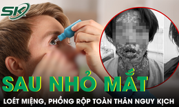 Loét miệng chảy máu, phồng rộp toàn thân nguy kịch sau khi tự dùng thuốc nhỏ mắt