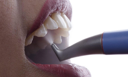 Lấy cao răng bằng hệ thống khí muối: phương pháp làm sạch răng hiệu quả