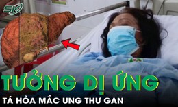 Ngứa 2 chân tưởng dị ứng, tá hỏa phát hiện mắc ung thư gan