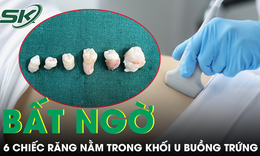 Bất ngờ 6 chiếc răng nằm trong khối u buồng trứng
