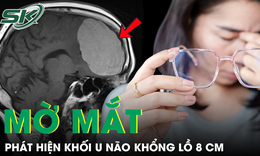 Mờ mắt kéo dài, người phụ nữ phát hiện khối u não khổng lồ 8cm
