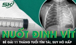 Bé gái 11 tháng tuổi tím tái, suy hô hấp sau khi nuốt đinh vít dài 4 cm