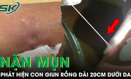 Phát hiện con giun rồng dài 20cm dưới da khi đang tự nặn mụn