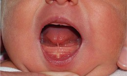 Dính thắng lưỡi ảnh hưởng thế nào đến trẻ?