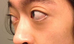 Lồi mắt Basedow cần làm gì?
