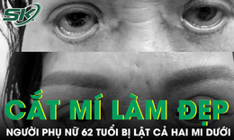 Biến chứng cắt mí thẩm mỹ, người phụ nữ 62 tuổi bị lật cả hai mi dưới