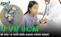 Bé gái 14 tuổi có khối u vú 8cm gây biến dạng