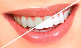 Thói quen xấu làm hại men răng thường gặp