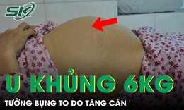 Tưởng bụng to do tăng cân, người phụ nữ phát hiện khối u nặng 6kg