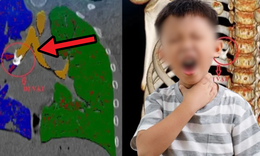 Bé 6 tuổi viêm phổi tái phát, bác sĩ tìm thấy thứ không ngờ trong phế quản