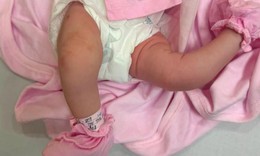 Bệnh viện Nhi Hải Phòng phẫu thuật thành công bé sơ sinh chân 'gập ngược' bất thường