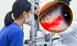 Bé gái 12 tuổi bị dây cáp quẹt vào mắt rách võng mạc