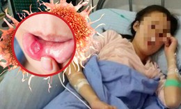 Cô gái 26 tuổi 'chết lặng' phát hiện ung thư giai đoạn 3 khi khám nhiệt miệng