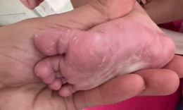 Bé gái 3 tháng tuổi mắc giang mai bẩm sinh