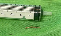 Mắc xương cá, người đàn ông phải cắt bỏ tuyến dưới hàm