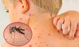 7 dấu hiệu cảnh báo sốt xuất huyết chuyển nặng sau khi hết sốt