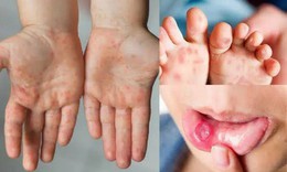Đừng chủ quan với bệnh tay chân miệng: Thấy 6 biểu hiện này cần đi khám sớm