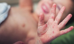 Tay chân miệng gia tăng, cha mẹ cần làm gì để bảo vệ trẻ khỏi nguồn lây?