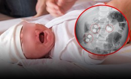 Bé 13 tháng tuổi quấy khóc đi khám phát hiện 6 viên sỏi trong bụng