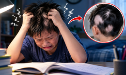 Ôn thi căng thẳng, bé trai tự nhổ tóc đến trơ từng mảng da đầu