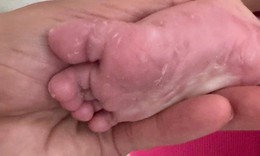 Bé gái 3 tháng tuổi mắc giang mai bẩm sinh do mẹ nhiễm bệnh khi mang thai