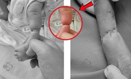 Mắc dị tật hiếm 1/15.000 ca, bé sơ sinh bị 'sợi dây ẩn' thắt nghẹt