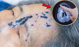 Đắp lá chữa bóng nước, cụ bà suýt mù mắt vì biến chứng zona thần kinh