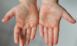 Dung dịch sát khuẩn tay chân miệng cho trẻ loại nào an toàn, giá tốt?