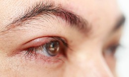 Những yếu tố làm tăng nguy cơ lẹo mắt