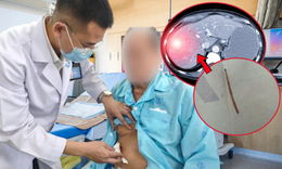 Người đàn ông sốc nhiễm trùng, bác sĩ phát hiện xương cá nằm trong gan