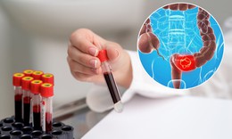 Ung thư đại trực tràng có chữa được không?