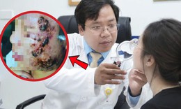 Tin lời sạch mụn sau 3 ngày, nữ sinh 20 tuổi mặt sưng nề 'như ong đốt'