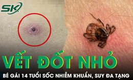 Bé gái 14 tuổi sốc nhiễm khuẩn, suy đa tạng từ một vết đốt dưới ngực