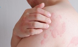 Nổi mề đay có nguy hiểm không?