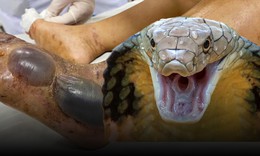9 người bị rắn độc cắn may mắn thoát 'cửa tử' nhờ huyết thanh kháng nọc