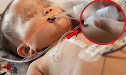 Bé gái 19 tháng tuổi cấp cứu ngưng thở vì ngộ độc thuốc nhỏ mũi