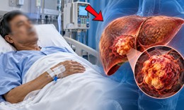 Ung thư gan ‘nhắm’ đến ai, yếu tố nguy cơ cần đặc biệt lưu ý