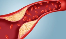 3 hiểu lầm phổ biến về mỡ máu