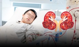 Mới 16 tuổi đã suy thận cấp, chi chít sỏi đầy hai quả thận