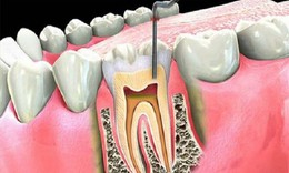 Viêm quanh răng gây hệ lụy gì?


